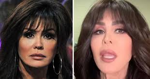marie osmond cosmetic surgery