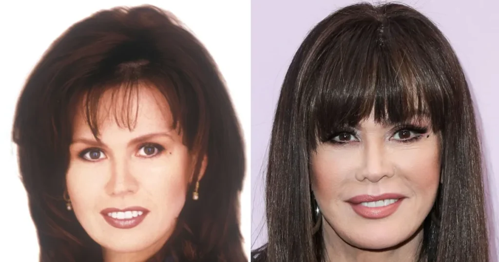 marie osmond cosmetic surgery